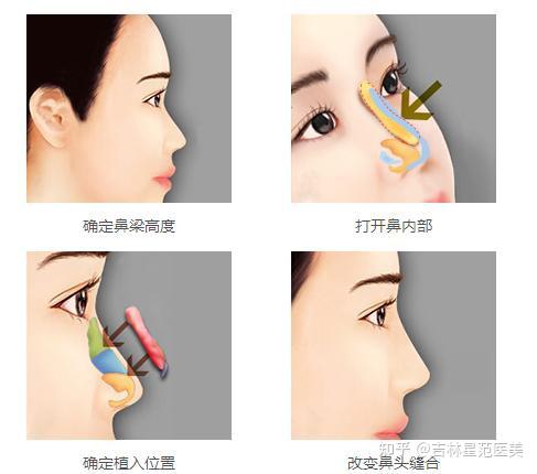 鼻梁和山根是一回事吗 知乎