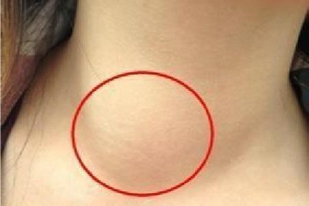 首大赵桂丽造成结节性甲状甲状腺肿的原因有那些生活中要注意些什么