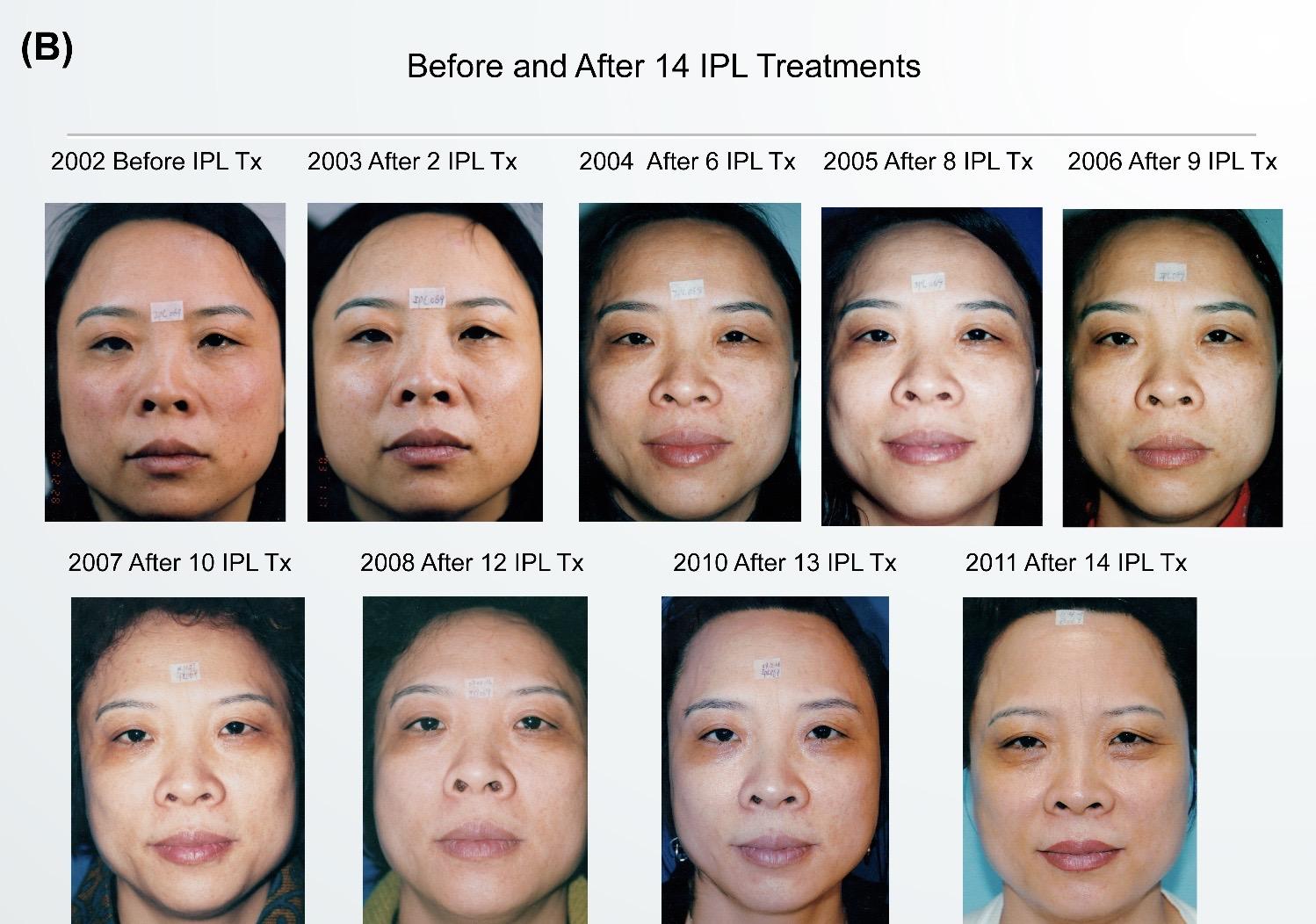 光子嫩肤最全科普,别再IPL OPT AOPT BBL ICON傻傻分不清楚了! - 知乎