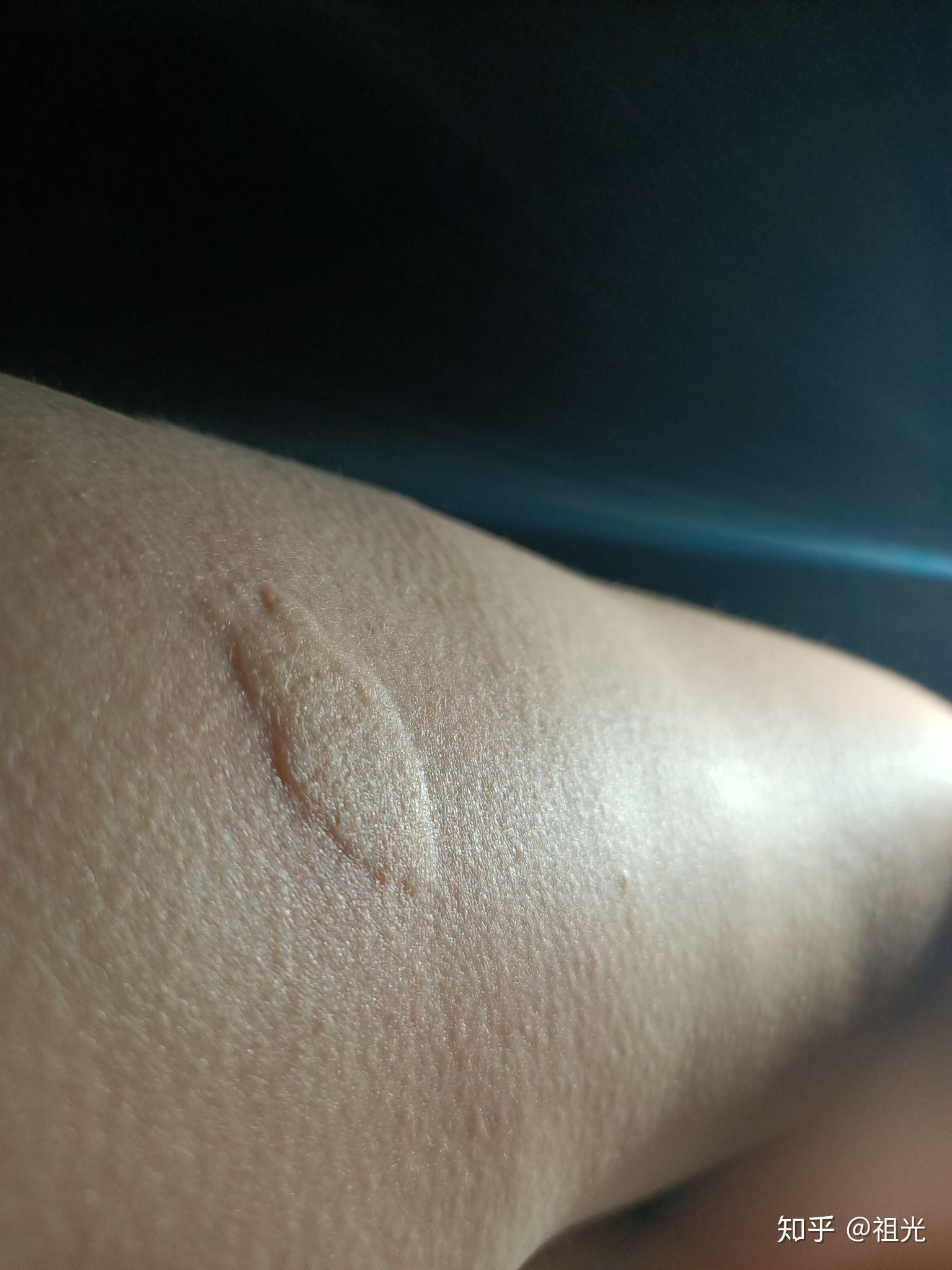 在户外被黑蚂蚁咬到怎么办