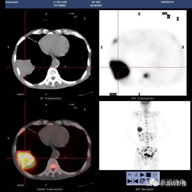 西安高尚医学影像petct在肿瘤治疗决策中的应用