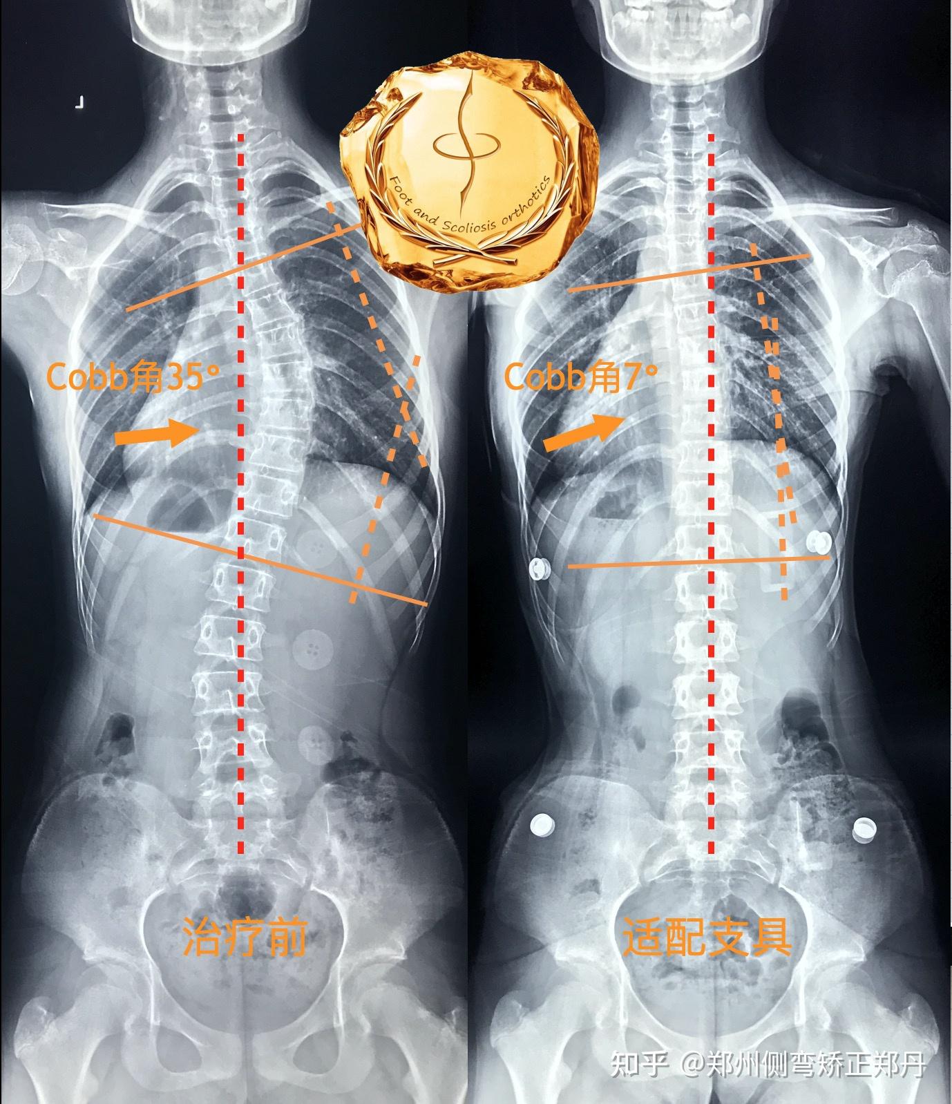 郑说侧弯案例分享