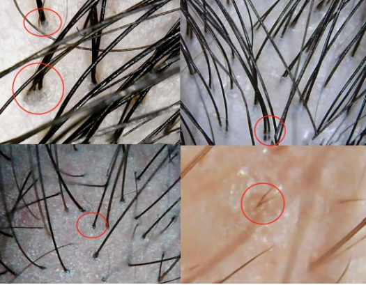 头皮毛囊堵塞导致掉发,怎么疏通?用什么洗发水? - 知乎