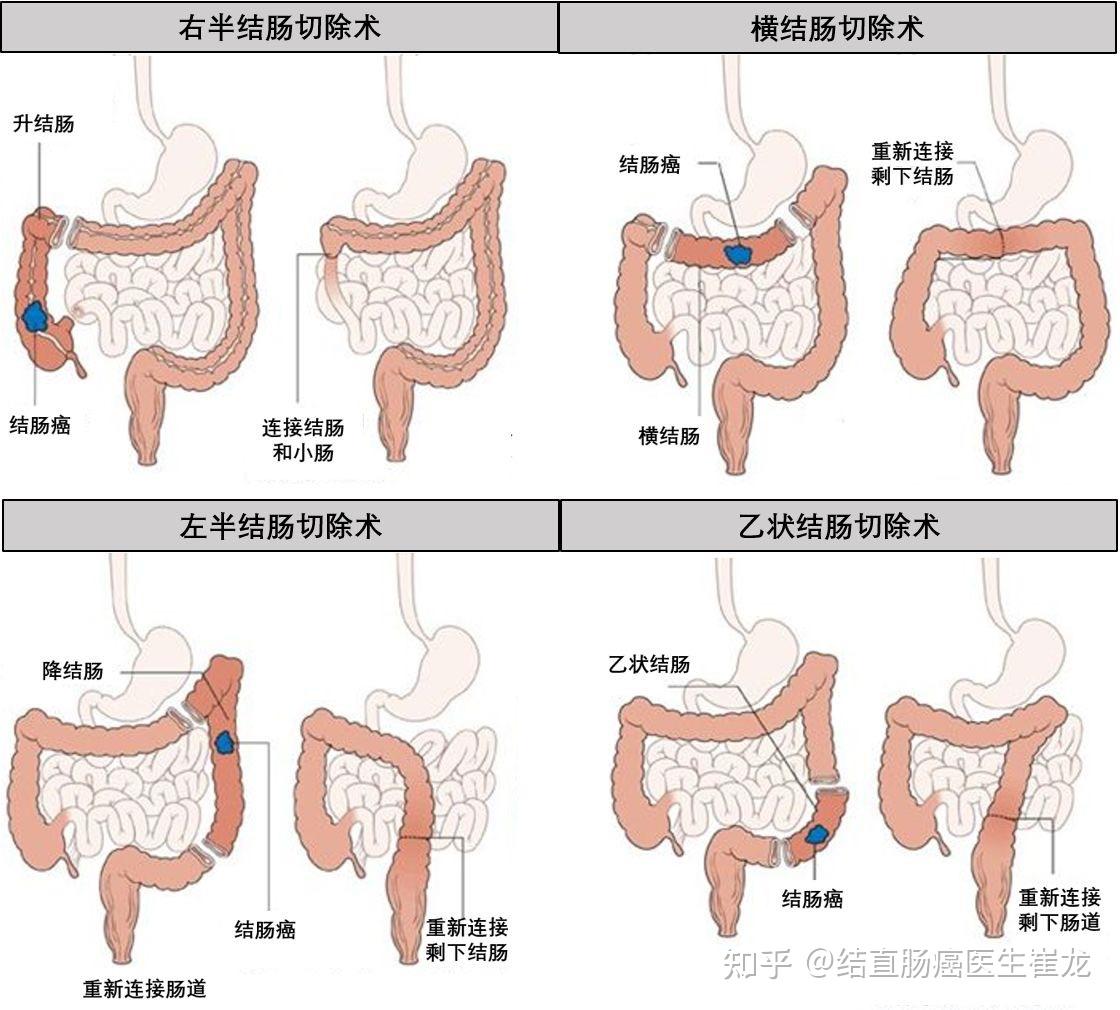 结肠脾曲的位置示意图图片