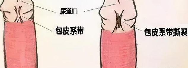 包皮系带撕裂了,应该怎么办?