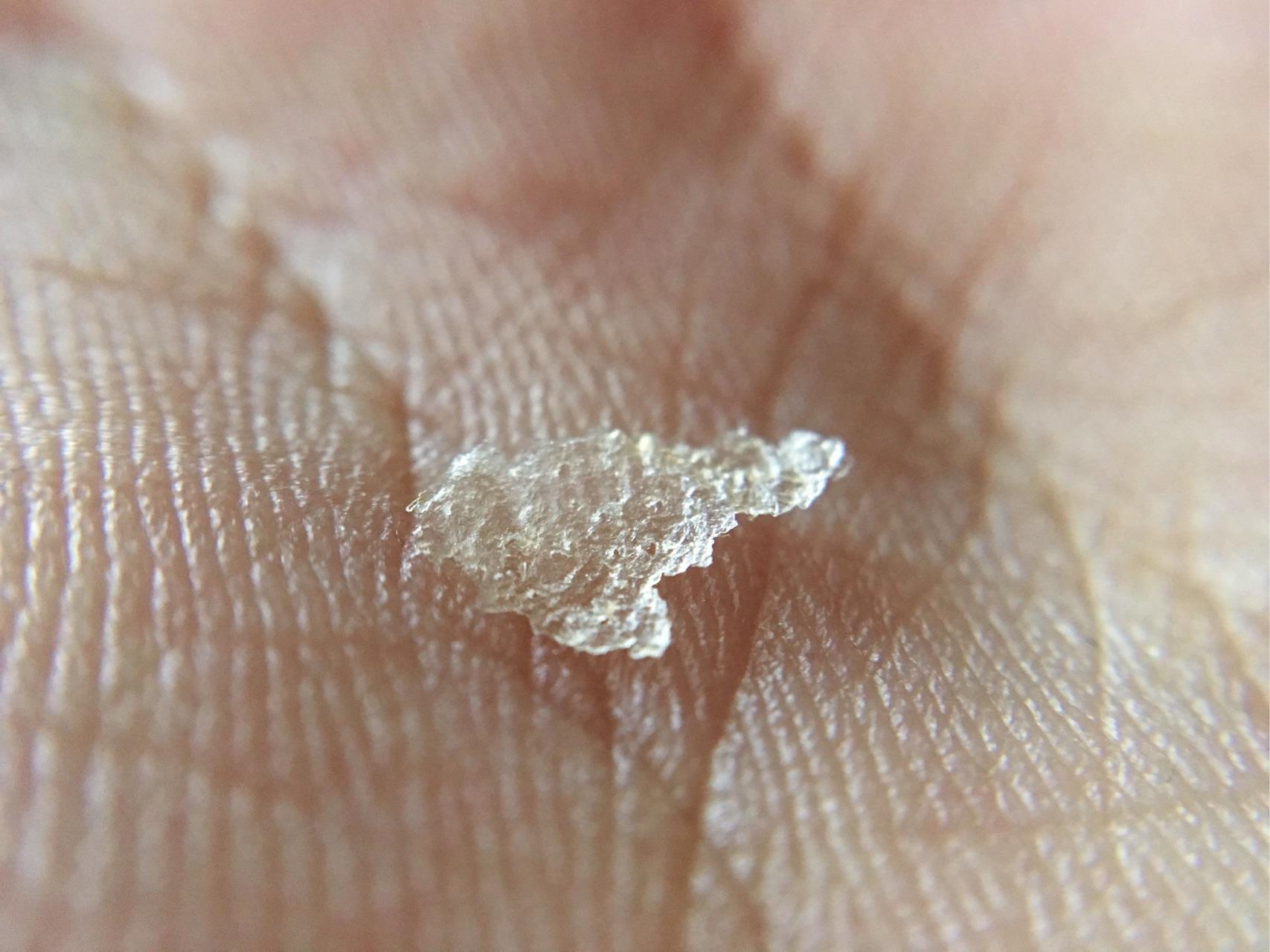 头皮屑很多是什么体验?