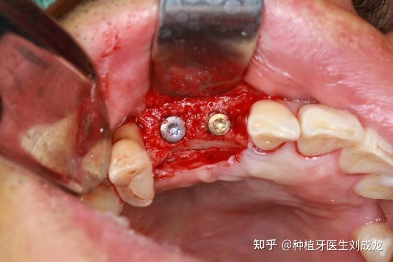 同时种植4颗瑞士iti种植体,顺利植入,初期稳定性良好,放入愈合基台,待