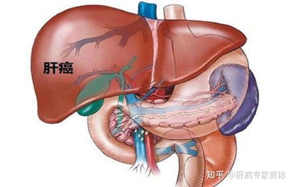 58歲男子上腹部出現小包塊,以為不是大事,結果竟是肝癌? - 知乎