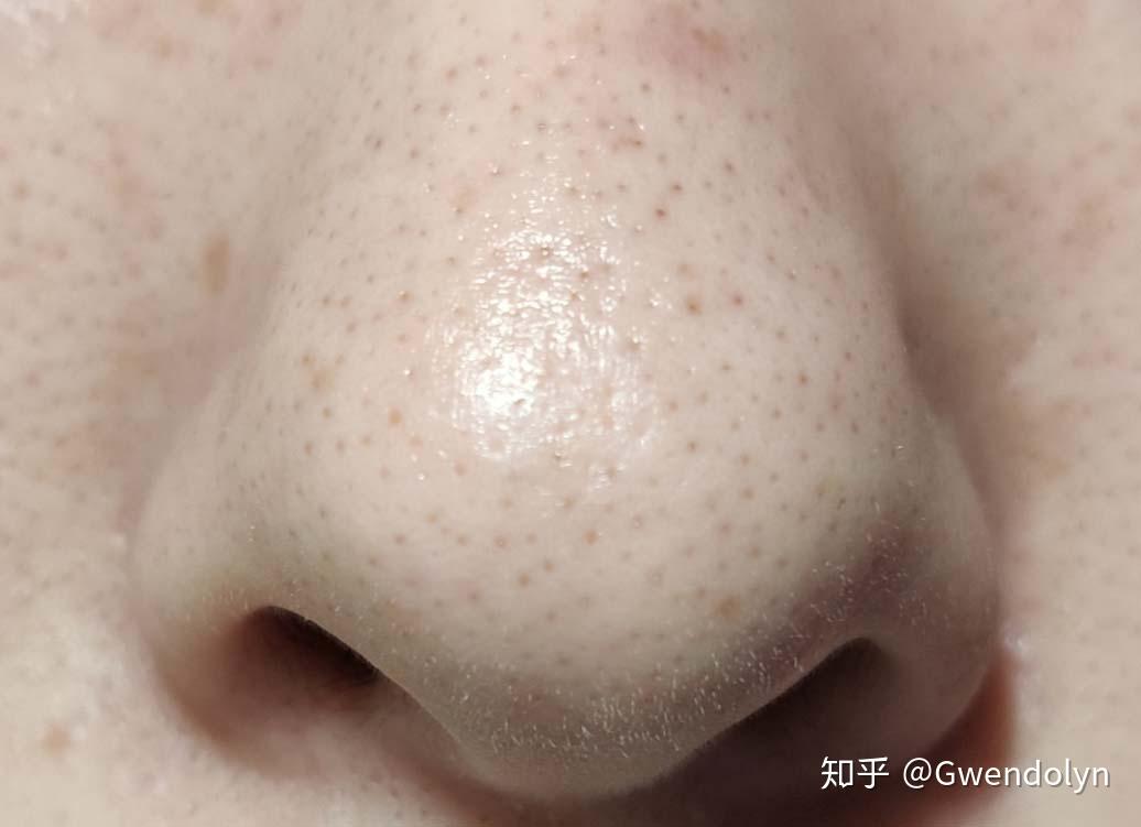 请问这种黑头如何去除