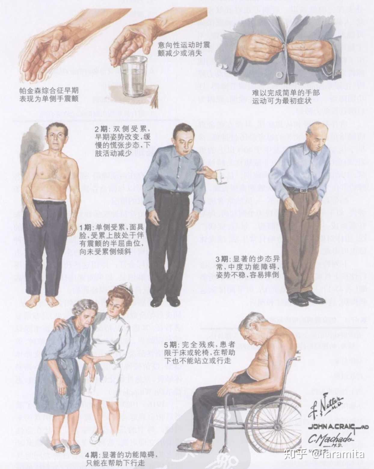帕金森基础知识1:概论 - 知乎