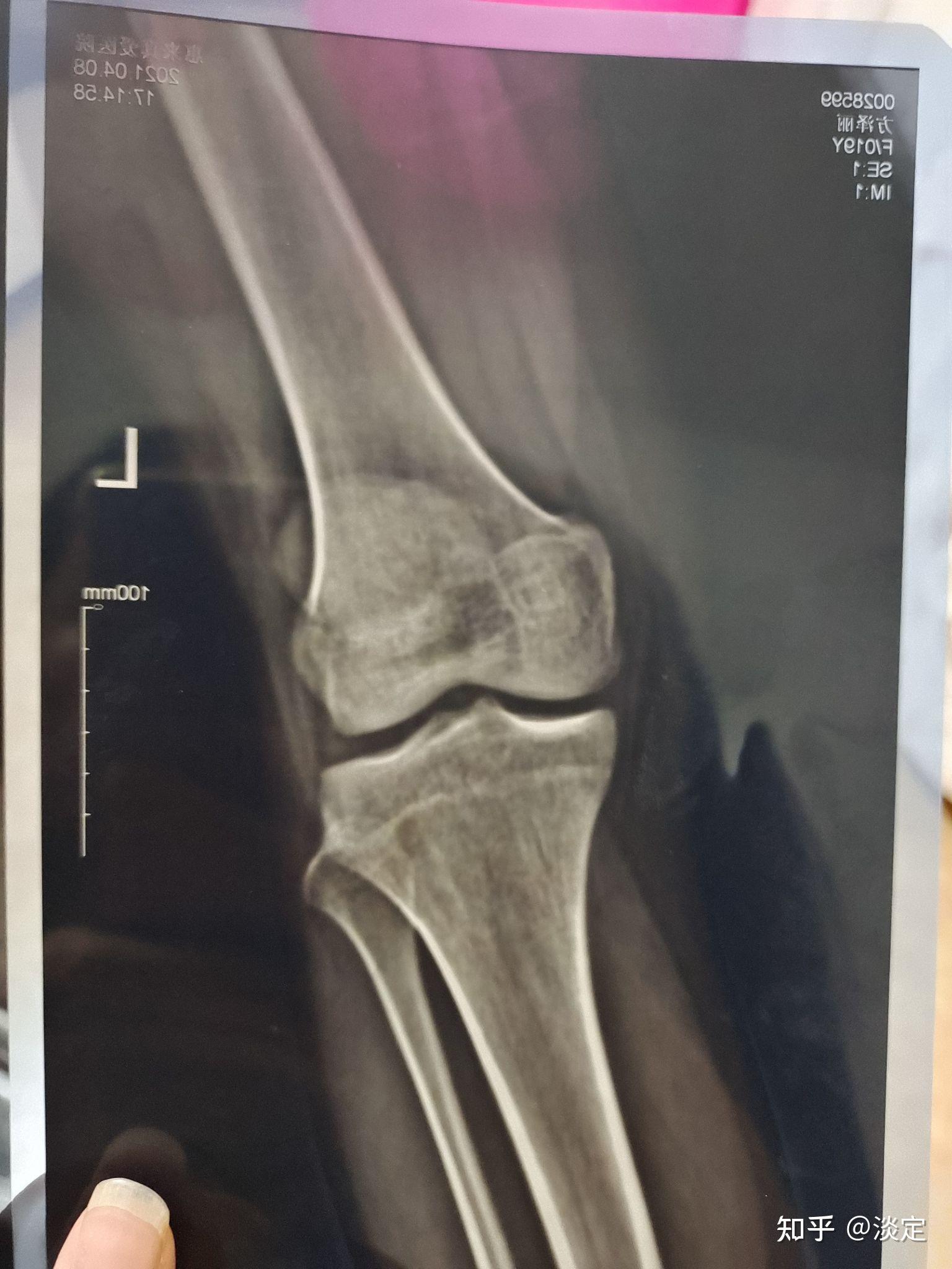 骨骺线接近闭合这么看? - 知乎