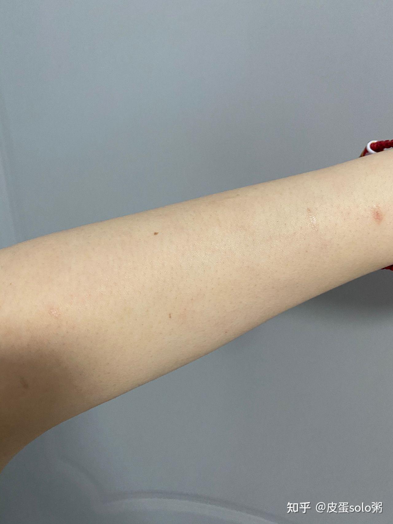 【祛疤日记】手术缝针一个月祛疤记录，亲身感受建议用疤痕贴_哔哩哔哩_bilibili