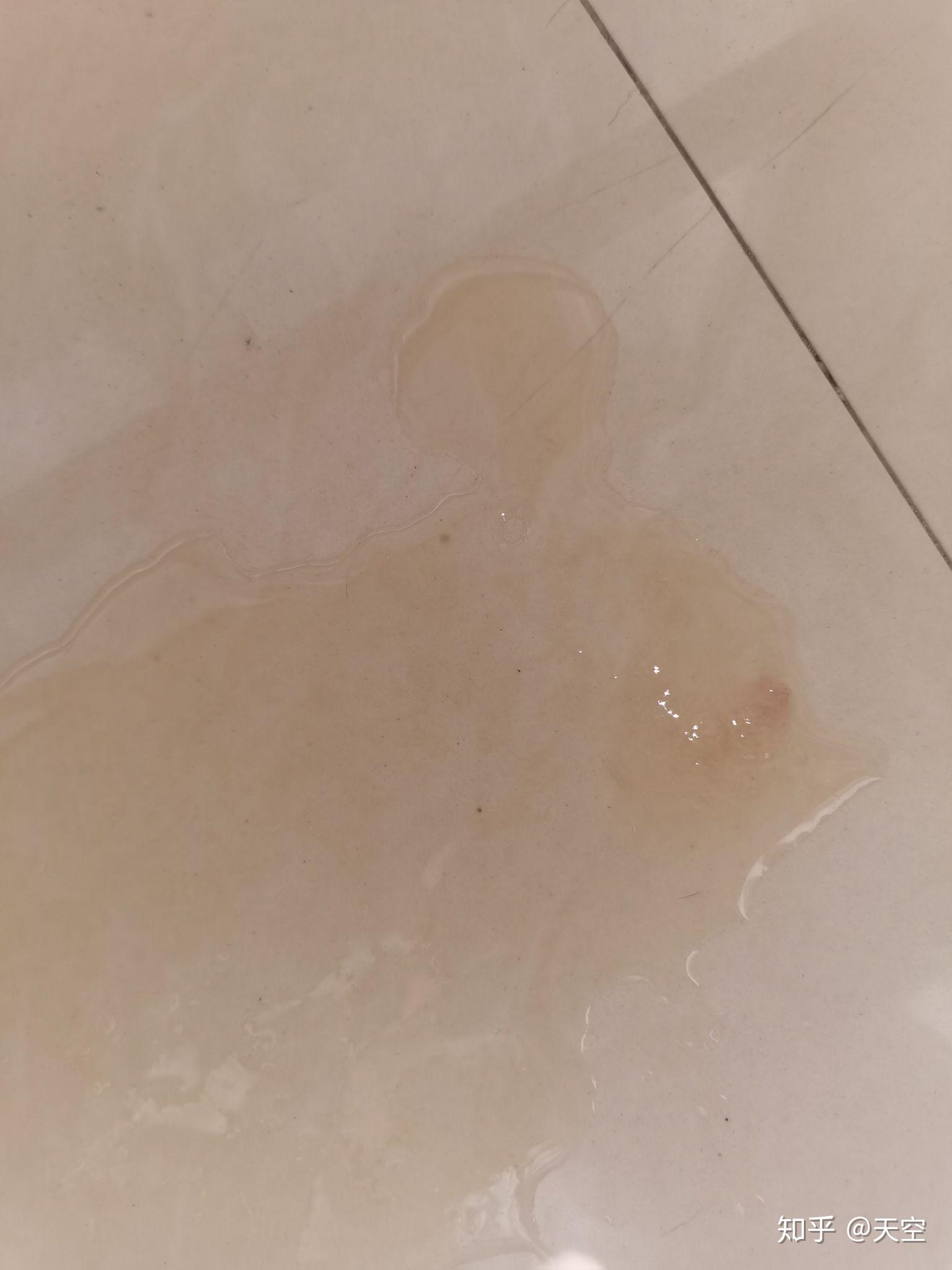 细小初期症状有什么? - 知乎