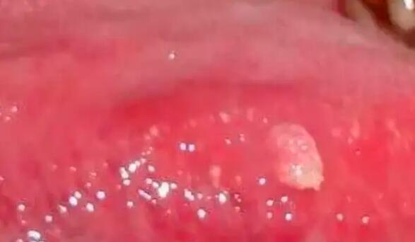 口腔感染hpv舌头图片