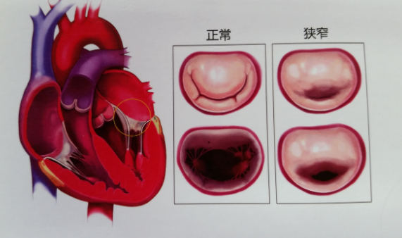 二尖瓣前叶前移图片