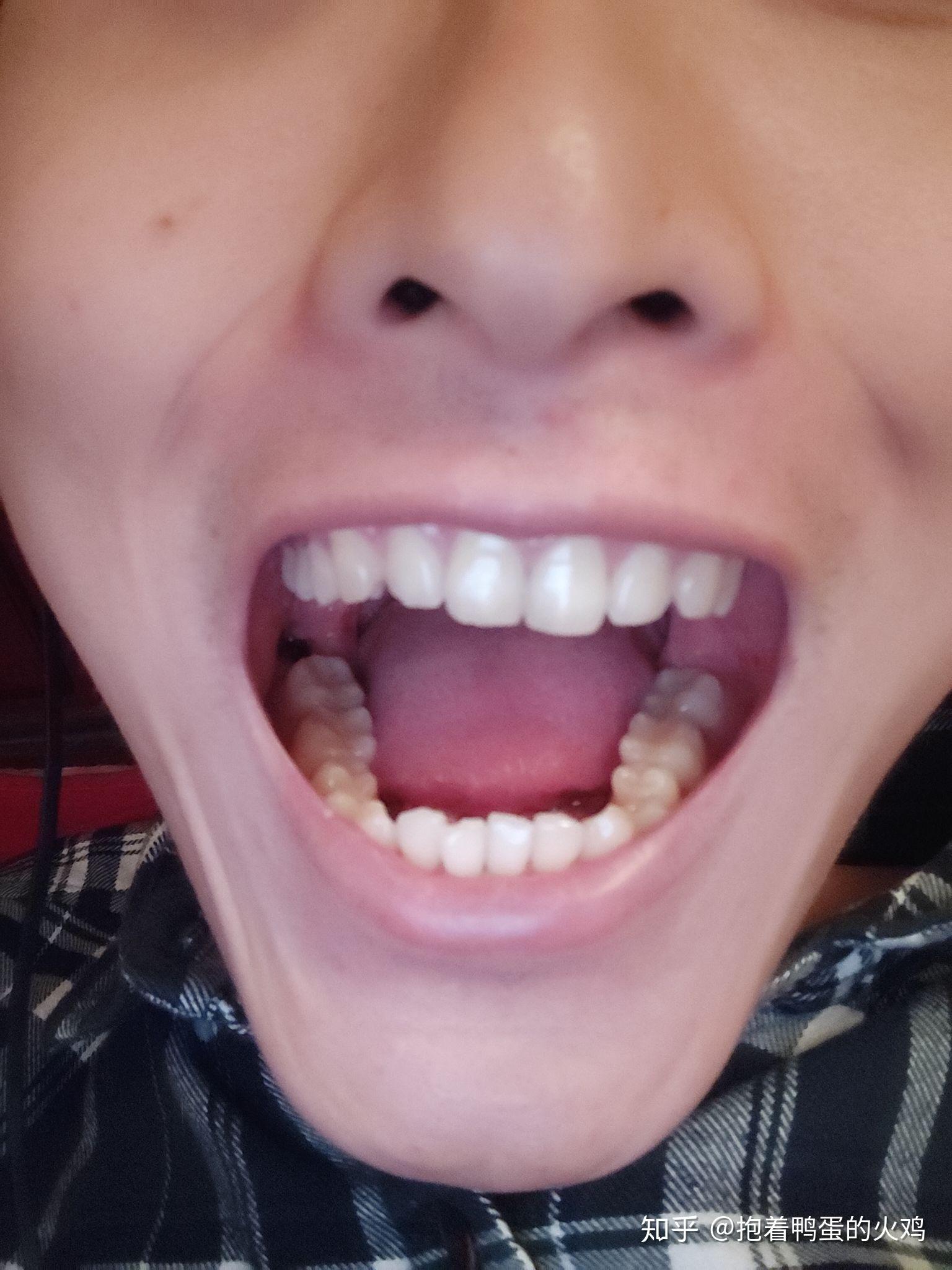 牙齿的自然咬合状态图片
