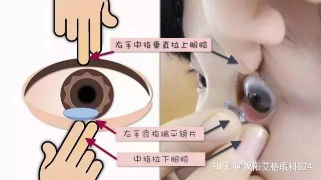 角膜塑形镜日常摘戴和护理你知道多少呢?