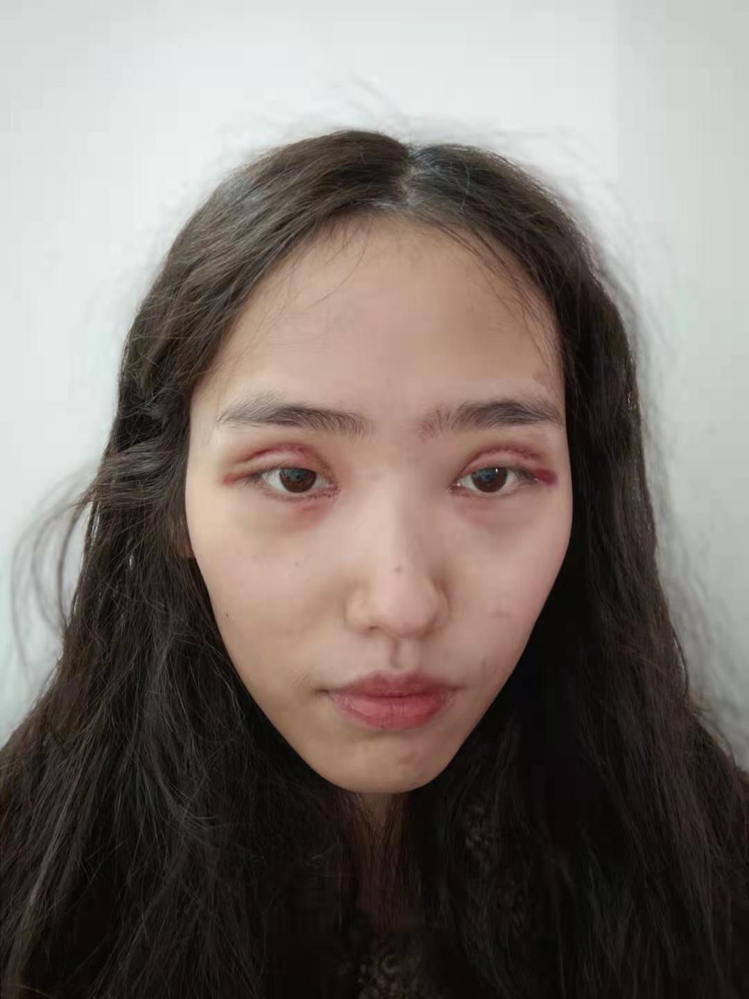 割眼皮 知乎