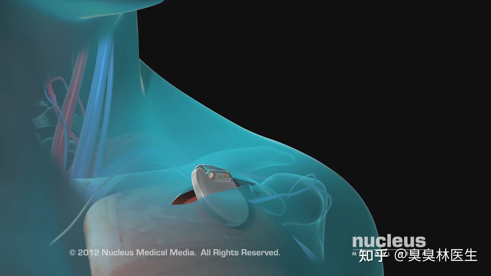 什么人需要心脏起搏器?它是怎么工作的?