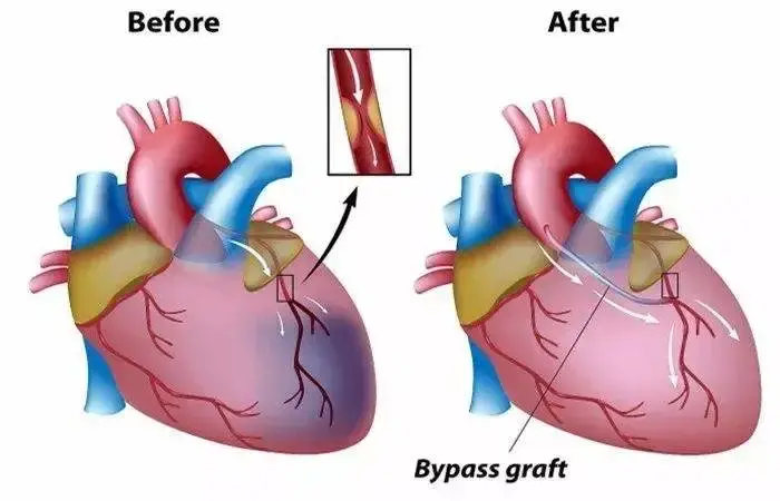 心脏搭桥手术示意图(bypass graft,动脉搭桥) | 图片来源:网络说完"不