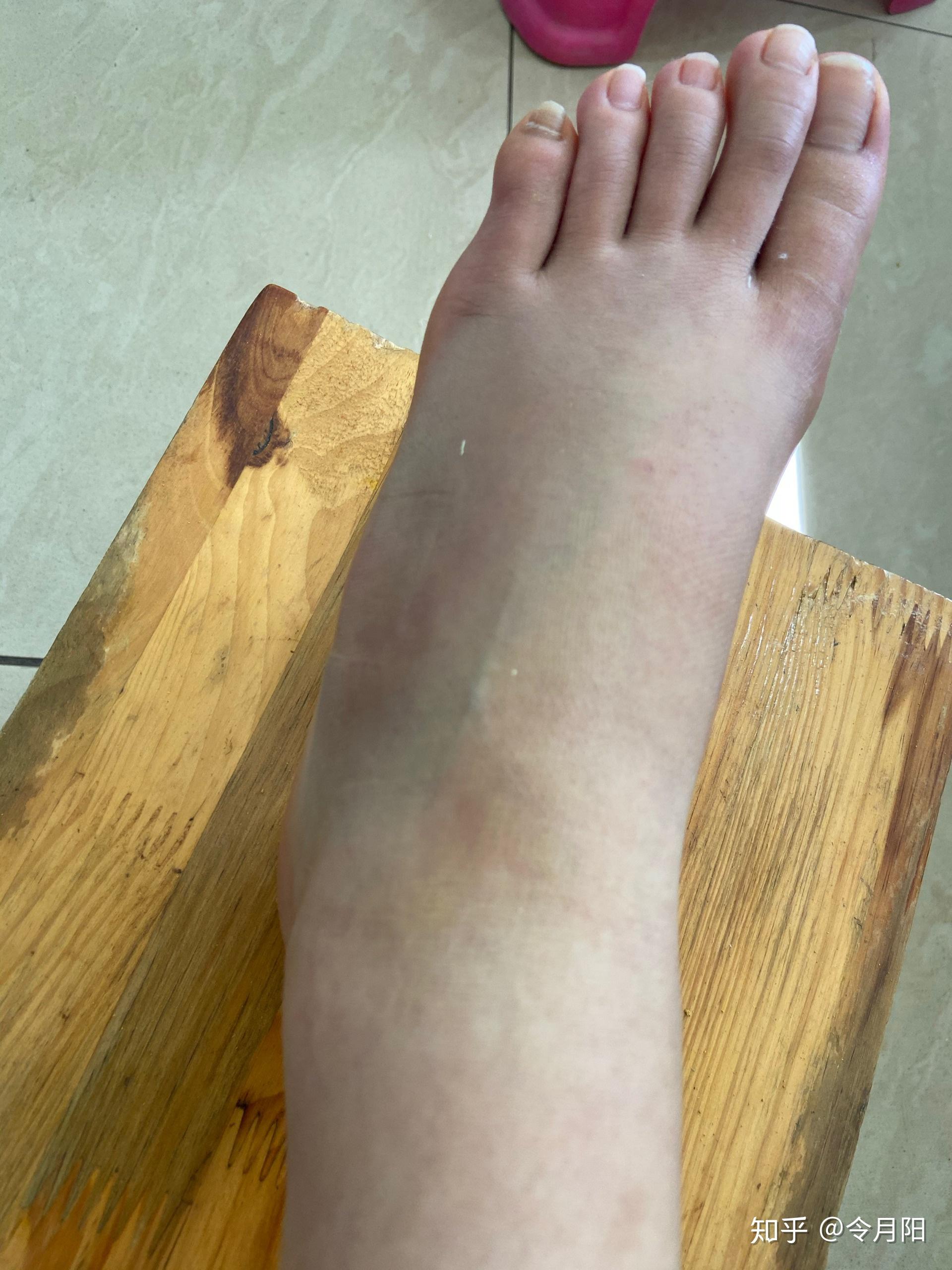 扭伤后脚背有肿块,请问怎么消肿? - 知乎