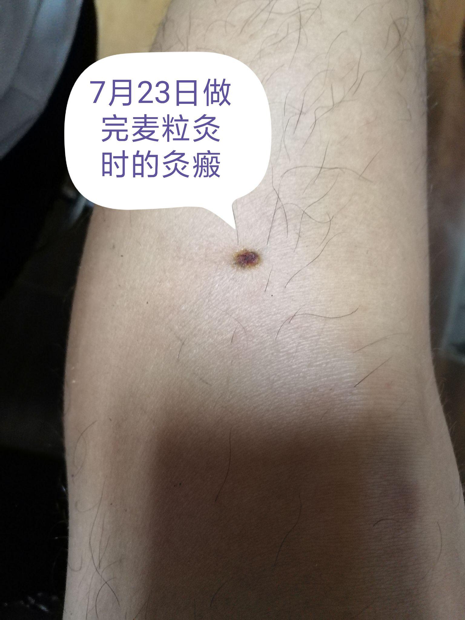 足三里瘢痕灸酸爽得不得了