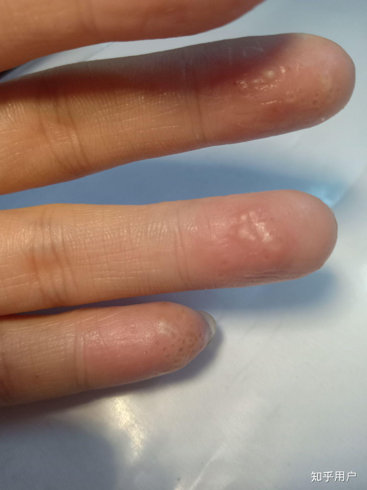 手指上长小水泡是怎么回事? - 知乎
