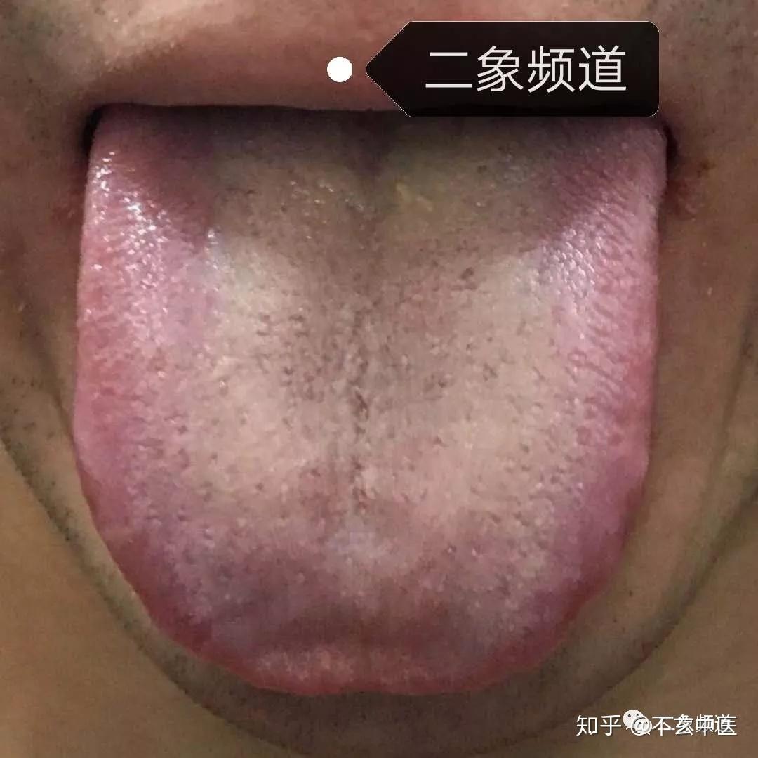 射精感遗精之中裂薄黄舌