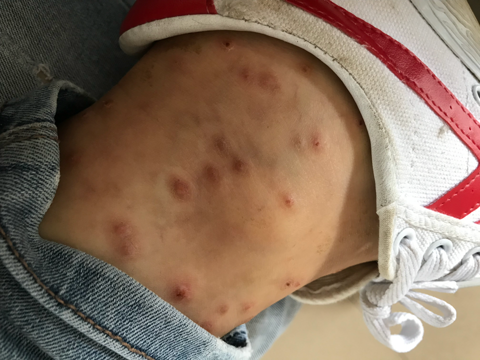 如何防止被黑蠓叮咬及叮后处理方法?