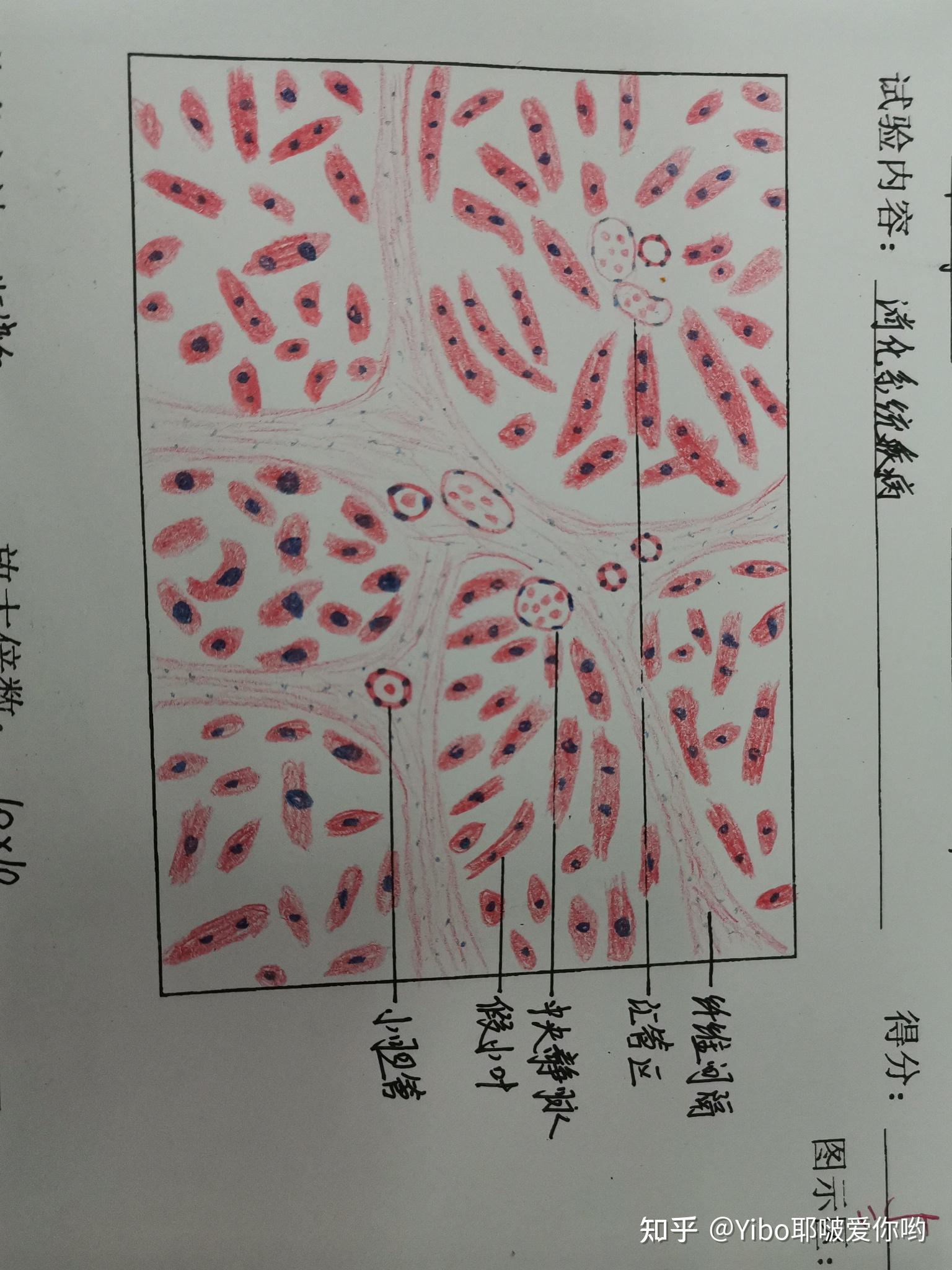 平滑肌肉瘤红蓝铅笔图图片