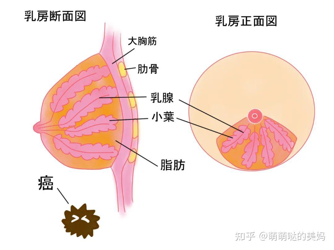 当乳房中的细胞开始不受控制地生长时,就会发生乳腺癌