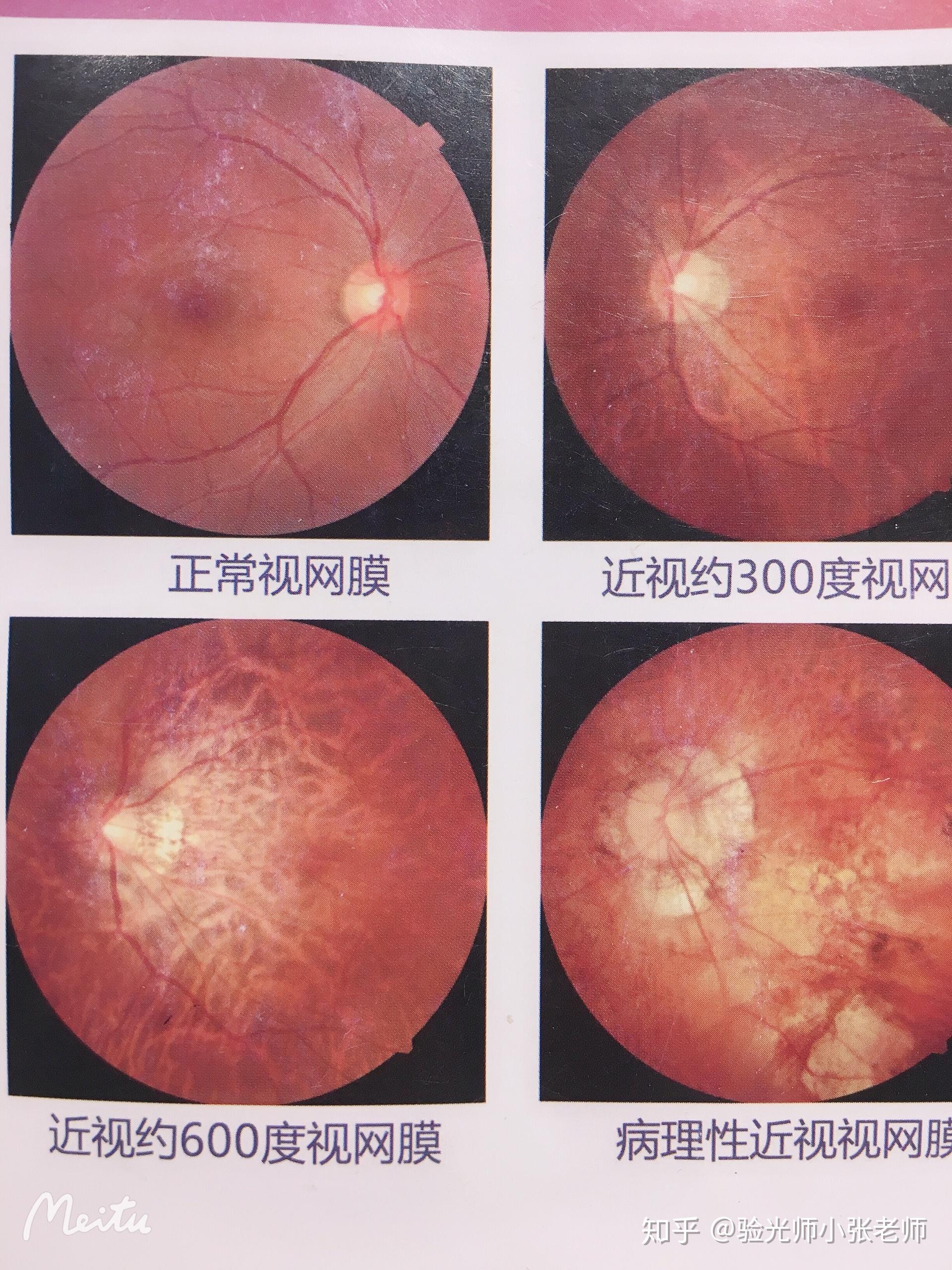 所以高度近视的人群每年都要定期检查一下眼底