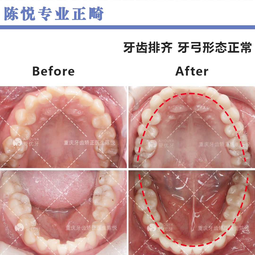 前牙改善深覆合,還能避免固定矯正過程中後牙大量墊高造成的咬合不適