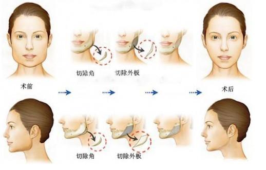 整形小知识颌面整形下颌角整形后脸容易下垂老得快