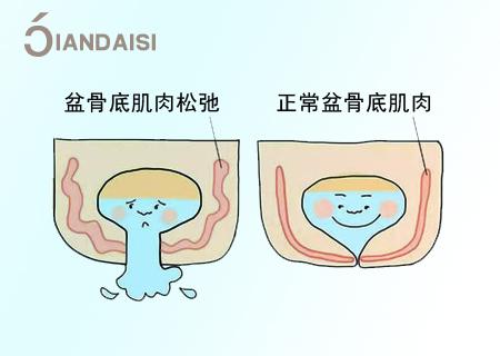 產後鬆弛漏尿怎麼辦建議鍛鍊盆底肌