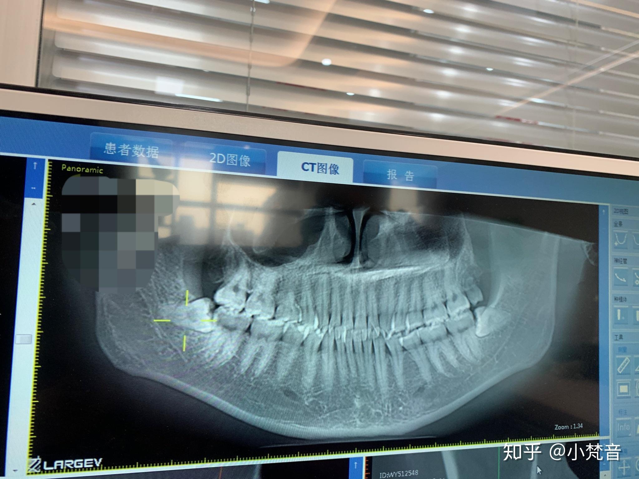 拔智齒和拔完智齒是怎樣一種體驗