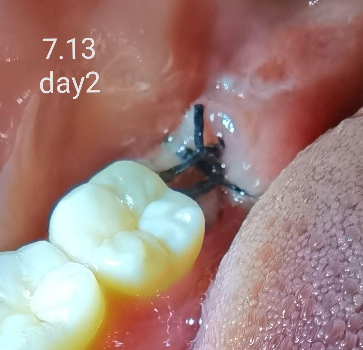 拨过智齿的亲们,你们的拨牙窝是怎样长平的? - 知乎