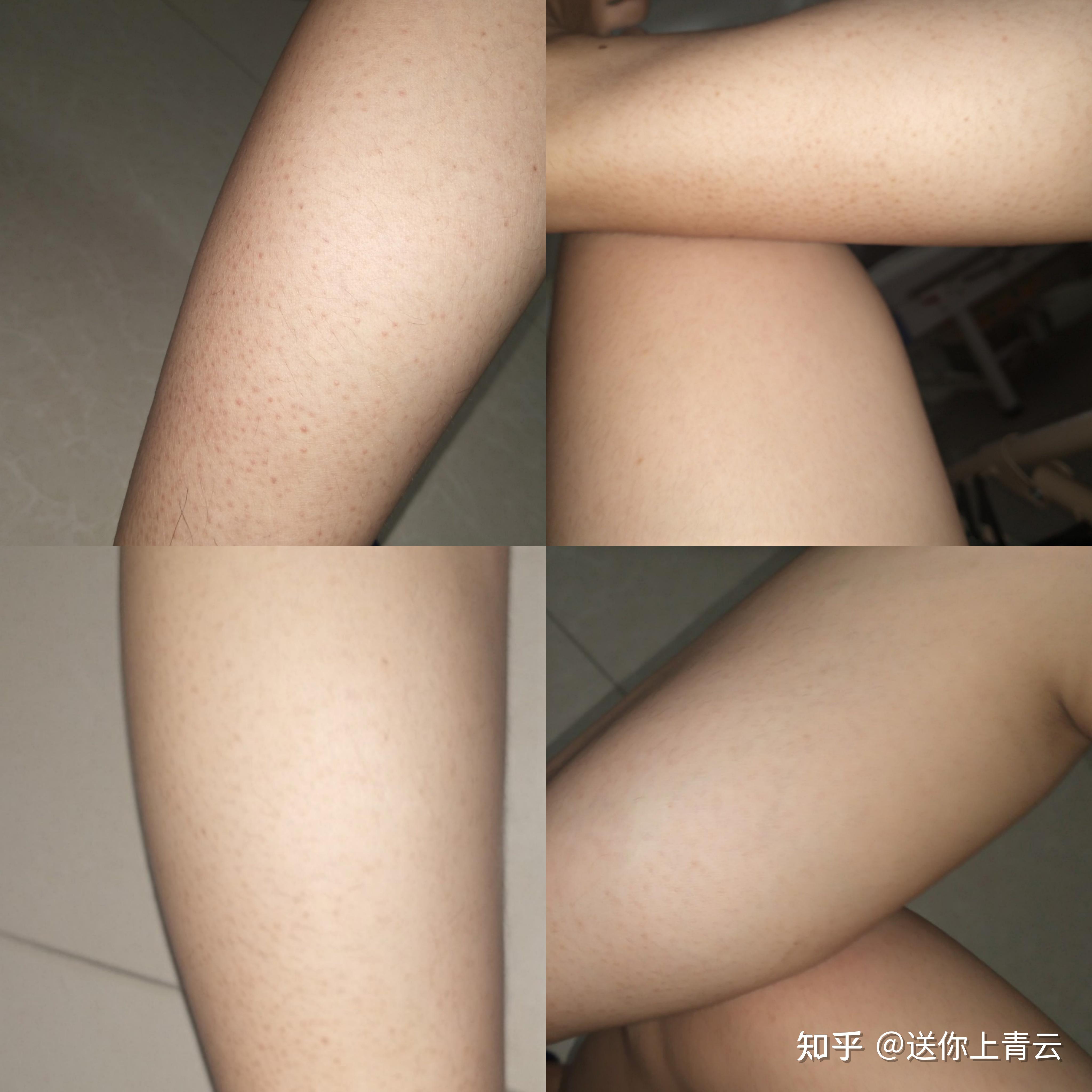 晚上睡觉老起鸡皮疙瘩(晚上睡觉起鸡皮疙瘩发冷)