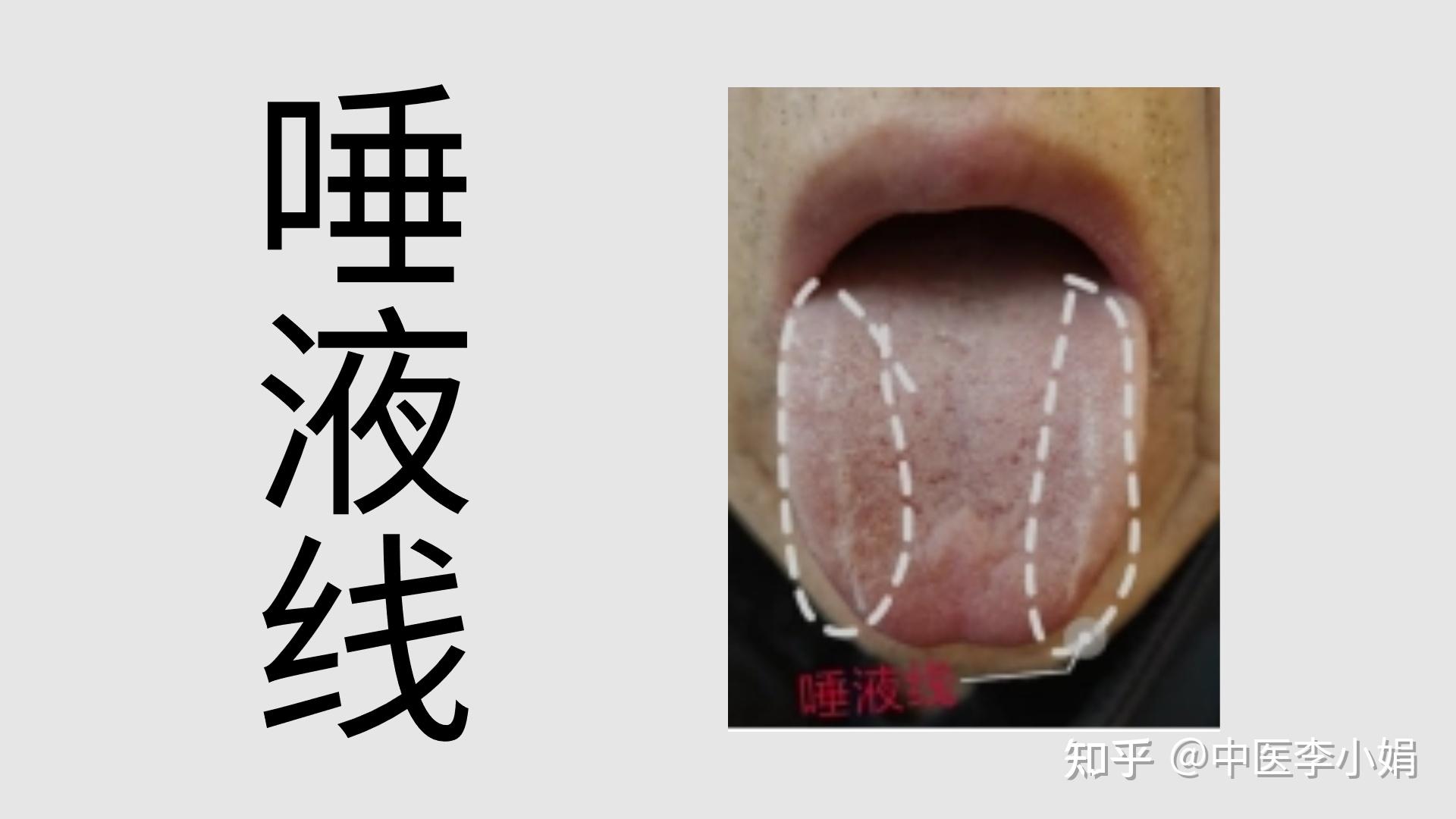 今日舌诊：同样是肝气郁滞，却有两个不同的舌像，你是哪一种 - 知乎