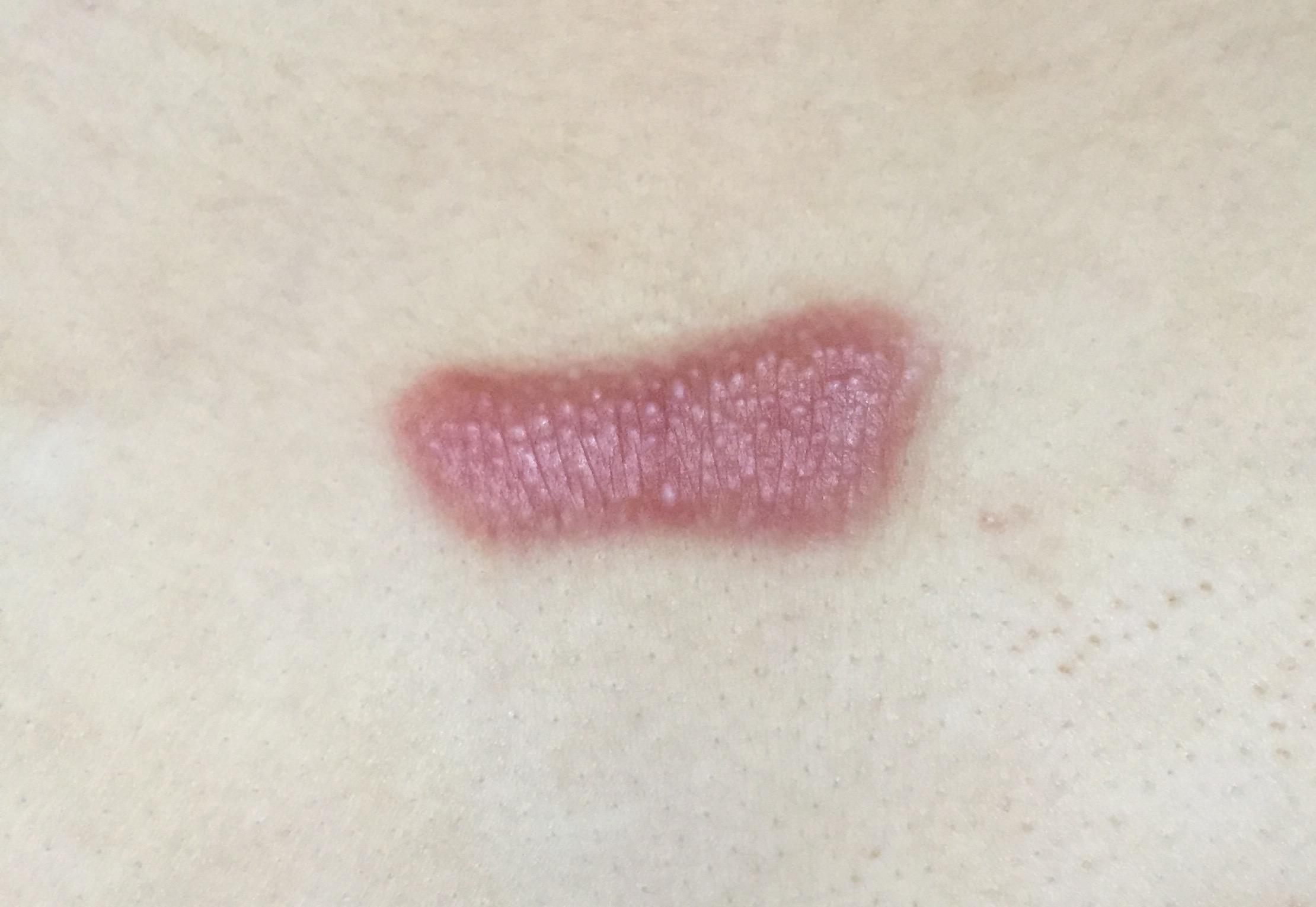 疤痕疙瘩到底怎么治?能不能治好?自己胸前长