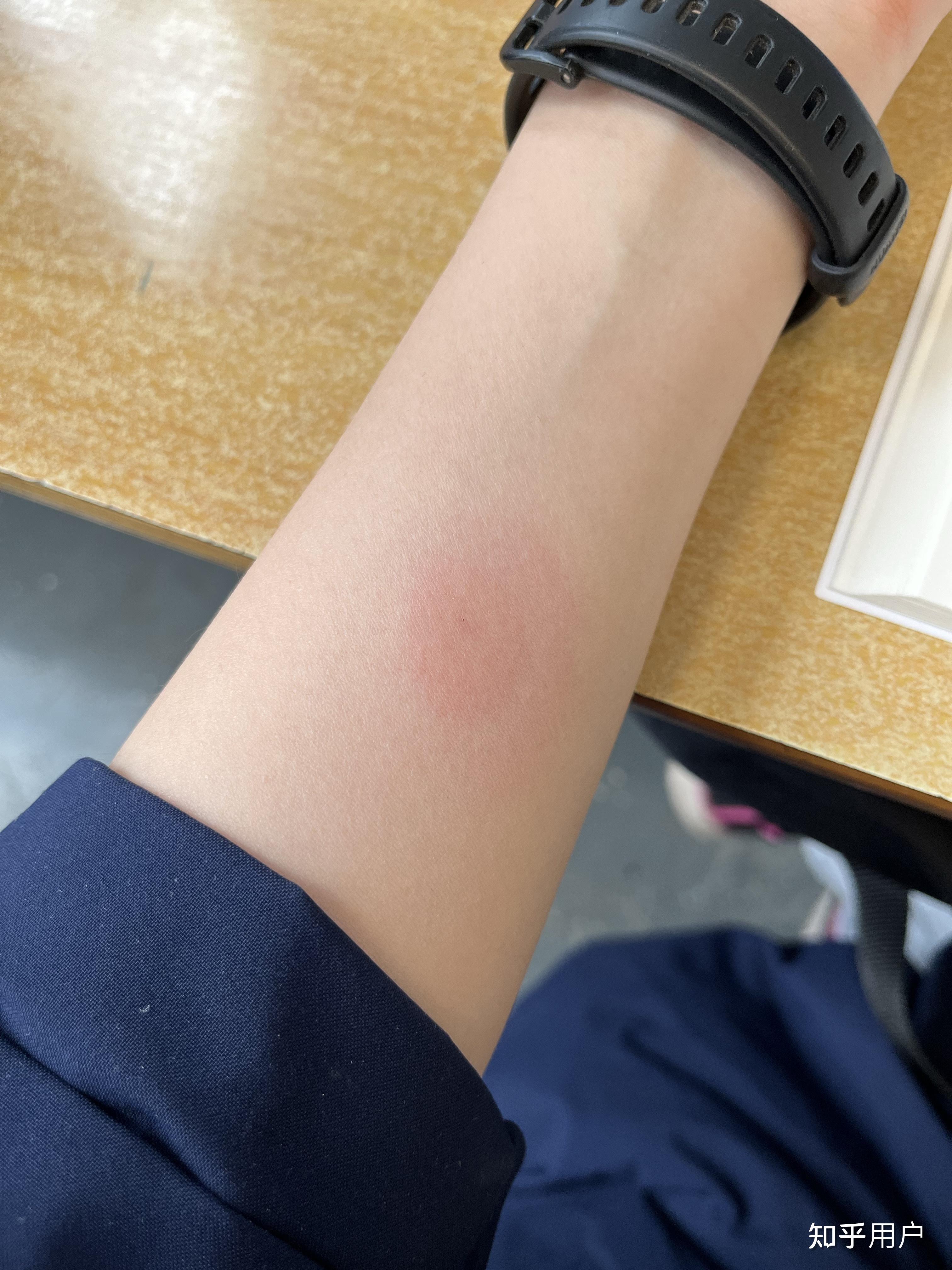 ppd试验是一种诊断结核的工具它是世界上两个主要结核菌素皮肤试验之