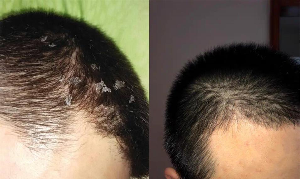 也是用过的,效果都是不太理想,这些洗发水用到的去屑成分都是吡硫鎓锌