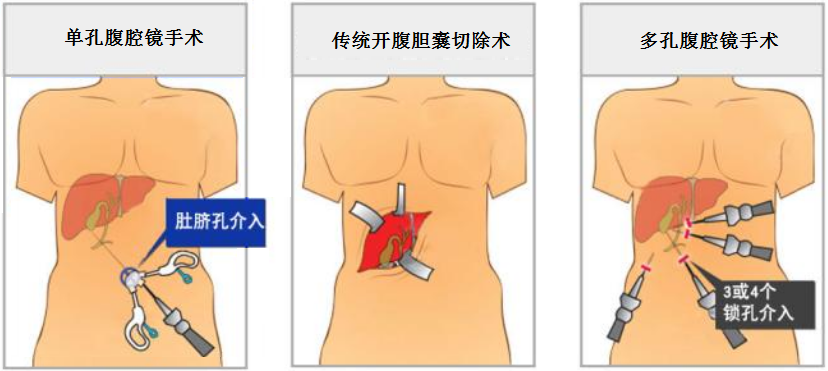 腹腔镜胆囊切除术适应症 术后注意事项有哪些 知乎