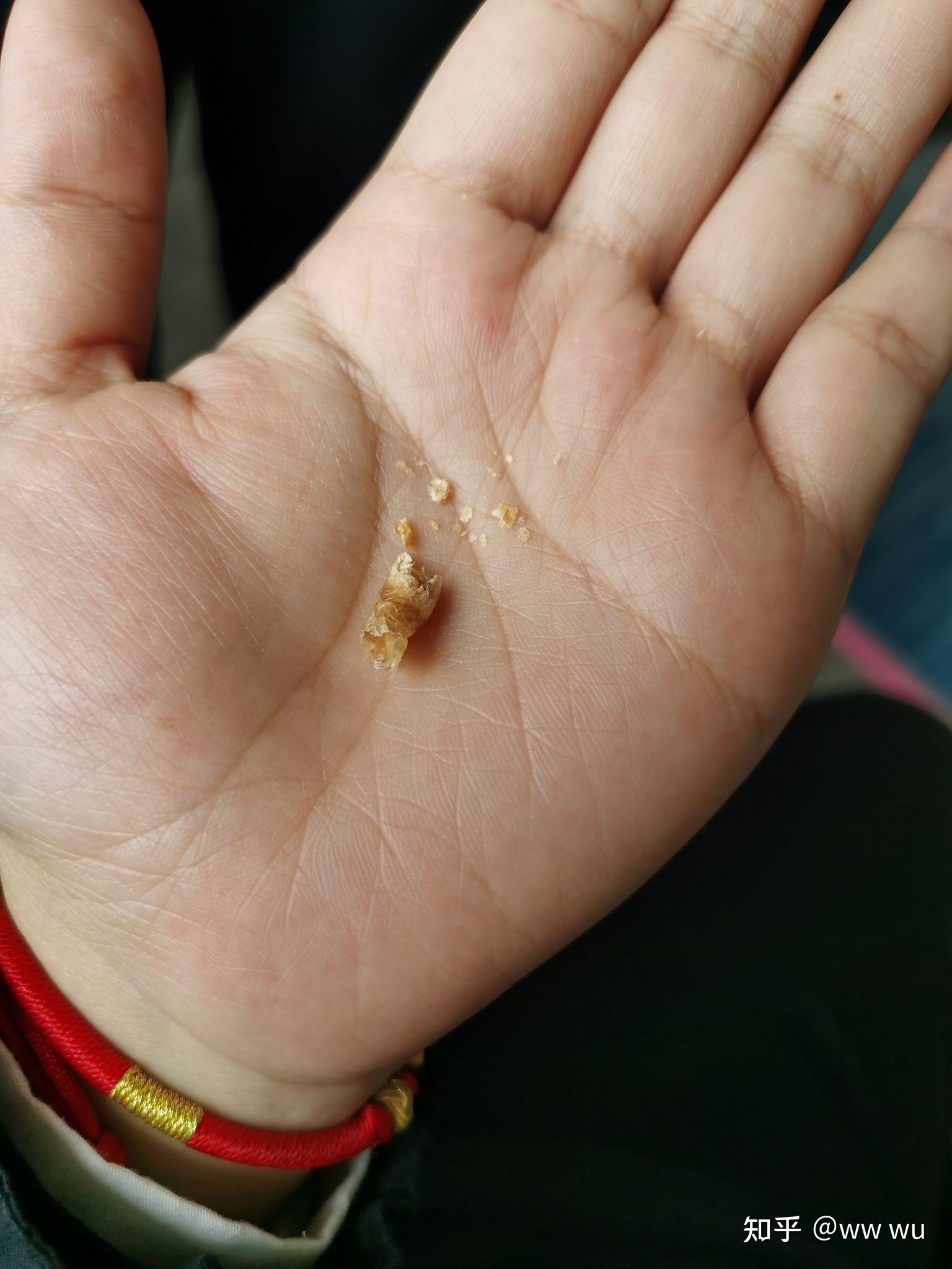 为什么我掏出来的耳屎是桶状的就是一层薄膜粘附在耳壁上