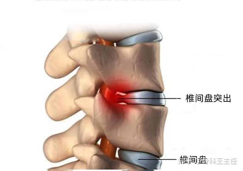 颈椎经常不舒服,疼痛,僵硬,是不是得颈椎病了? - 知乎