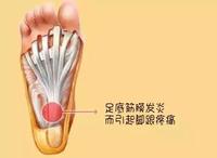 困扰多数跑者的足底筋膜炎