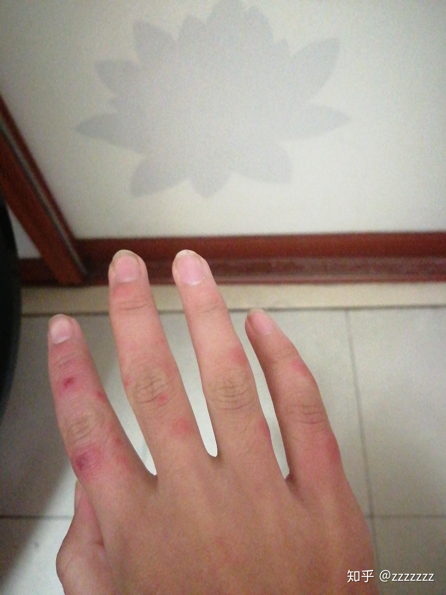 一双10多年的冻疮手好难看