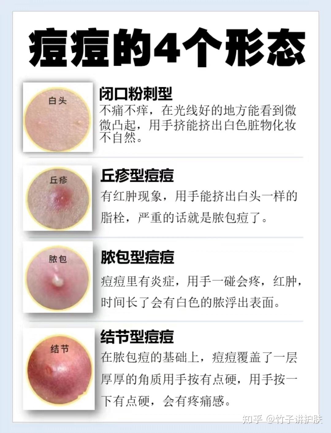 这个脸怎么办,是痘印吗? - 知乎