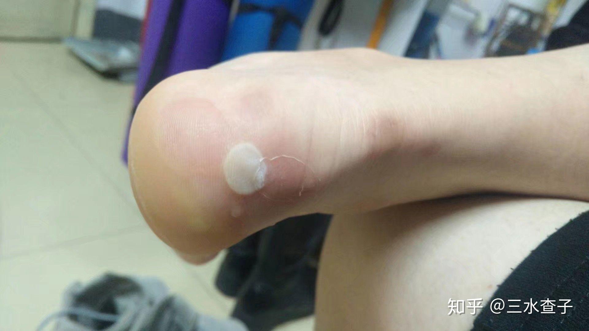 脚后跟磨出个水泡,要挑破么? - 知乎