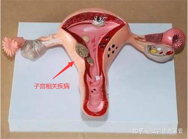 如子宮腺肌症,宮腔粘連,子宮內膜異位症,子宮肌瘤,縱膈子宮,單角子宮